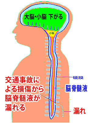 液が漏れてる状態